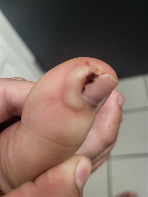 Process of ingrown toenail : r/MedicalGore