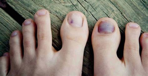 Black Toenails and Diabetes: Causes, Symptoms, and When to Seek Help
