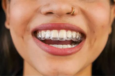 how to clean invisalign aligners