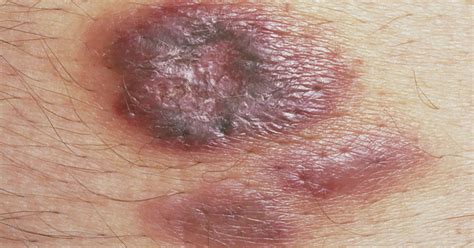 Symptoms Of Kaposi's Sarcoma - HealthPrep.com
