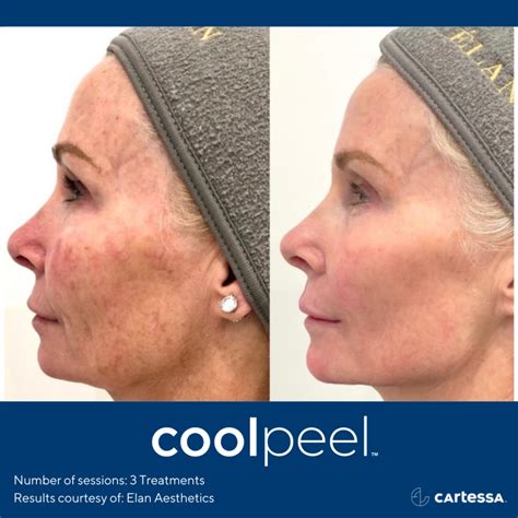 CoolPeel CO2 Laser Resurfacing Treatment in Jacksonville, Florida | Hello Smooth Med Spa