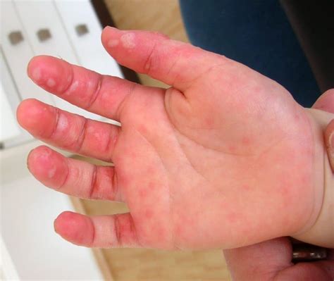 childhood rashes teachmepaediatrics