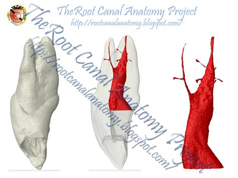 The Root Canal Anatomy Project: Two-Rooted Maxillary Central Incisor