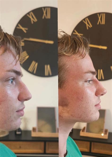 Teen goes viral as nose begins LEAKING pink fluid after botched filler