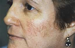 Facial Spider Vein Treatment | Facial Veins Treatment and Removal