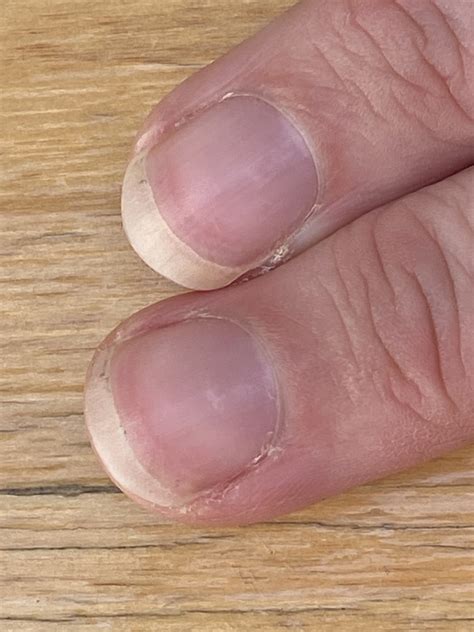 What your nails say about your health