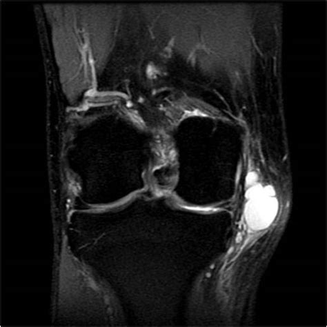 pes anserine bursitis radrounds radiology network