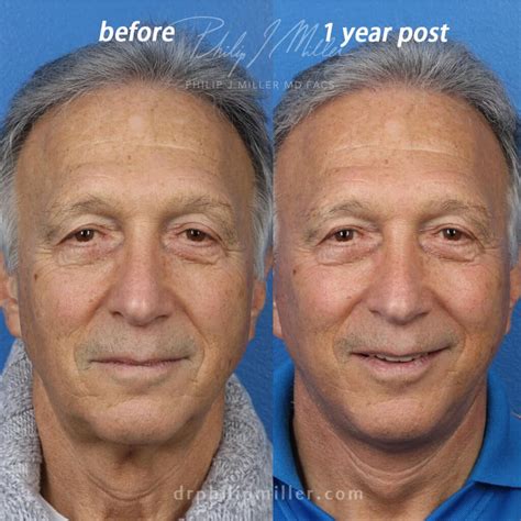 plastic surgery  men gotham plastic surgery