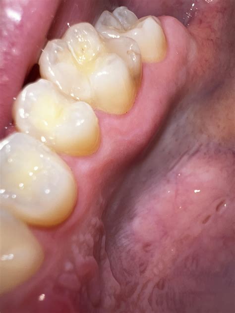 What are the two holes in the roof of my mouth? I’ve never noticed them
