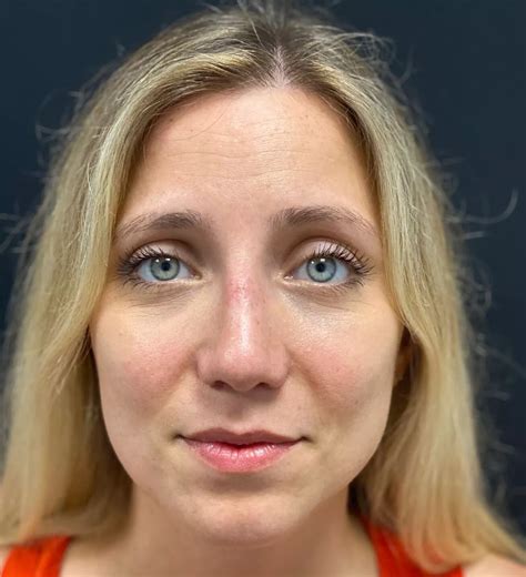 rhinoplasty nose surgery francesco gargano md