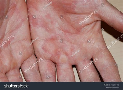 Hand Dermatitis Dyshidrotic Eczema Hands Stock Photo 2222043451 ...