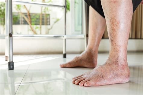 peripheral artery disease ae