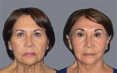 What’s The Best Age For A Facelift? | Buckhead Plastic Surgery | Blog