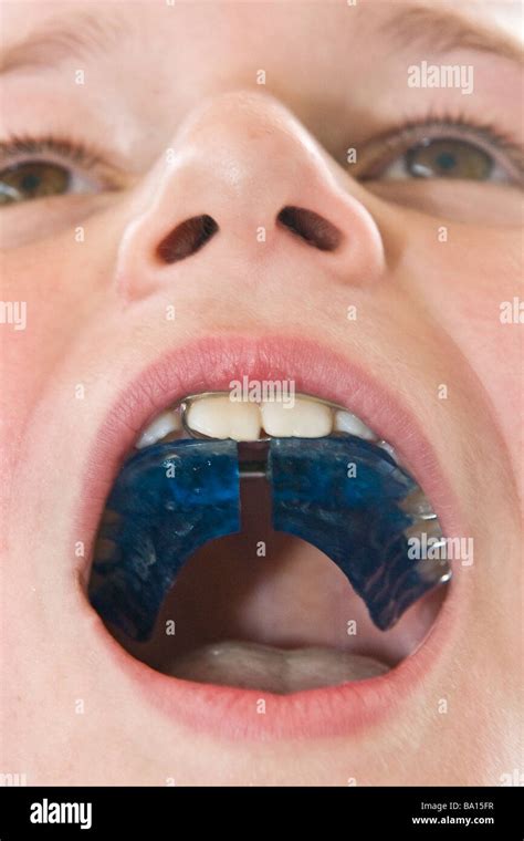 Orthodontics for children Stock Photo - Alamy