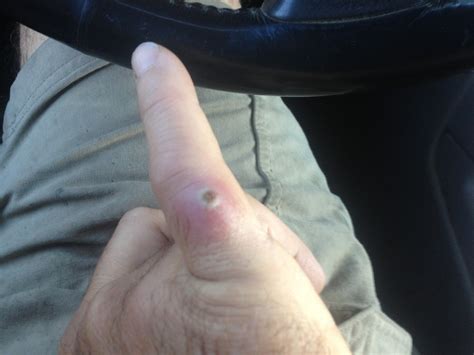 does clinda cover mrsa 9