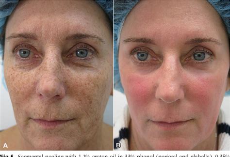 Figure 4 from Advanced chemical peels: phenol-croton oil peel ...