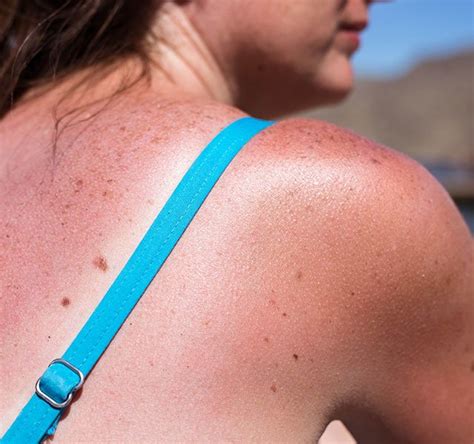 sunburn basics   sting   sunburn henry ford health