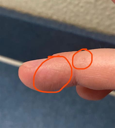 Have had a mark of lumps and some other more near the surface lumps on