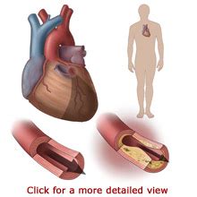 heart disease niva health