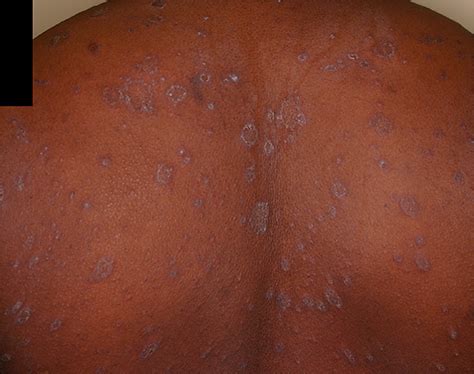pityriasis rosea pr school  medicine