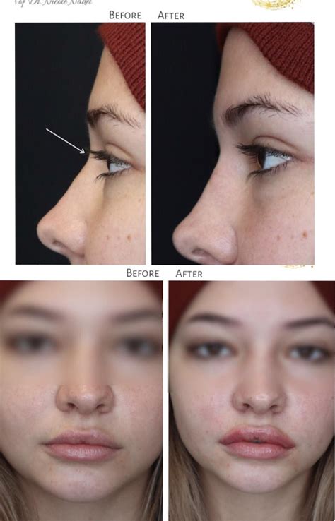 Pin by flor on Beauty treatments in 2025 | Rhinoplasty nose jobs, Nose