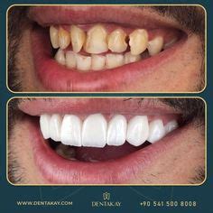 130 Hollywood smile Before and After ideas | smile makeover, smile design, make smile