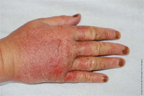 Dermatite Atópica Nas Mãos - A eczema das mãos | Fundação Eczema
