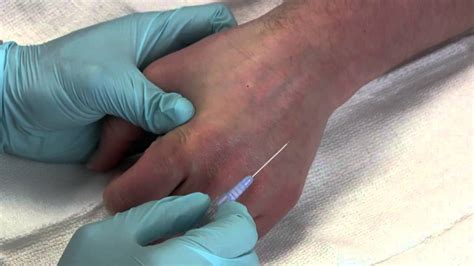 Intravenous Catheter Placement - YouTube