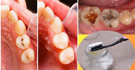 easily remove cavities    simple steps