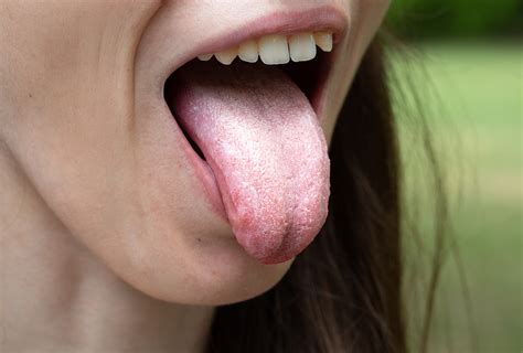 how to fix a white tongue