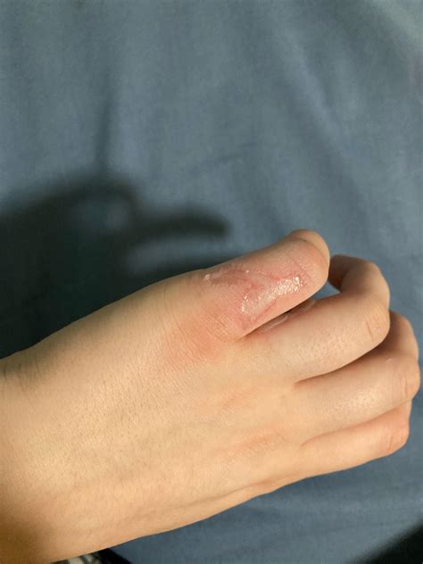 burn  days     infected rmedicaladvice