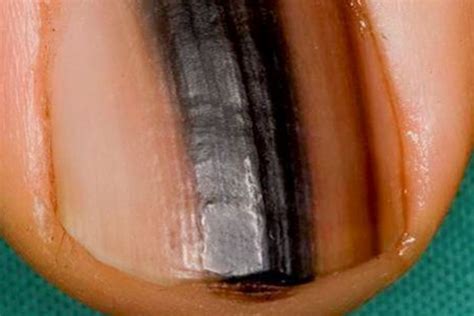 Normal Black Line Under Fingernail vs. Melanoma Streak » Scary Symptoms