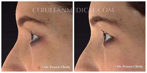 Mole Removal Kelowna Before and After Photos