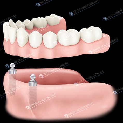 fixed removable denture jb dental image library