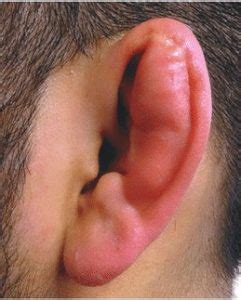 How To Avoid Cauliflower Ear in BJJ – BJJ More