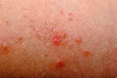 Immunity Disorders - What are Allergies? | Interactive Biology, with ...
