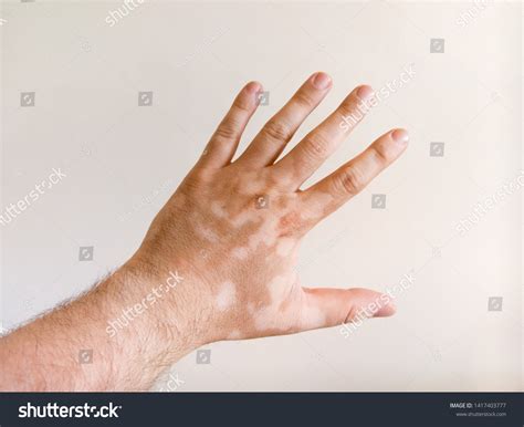 Caucasian Mans Hand Covered White Vitiligo Stock Photo 1417403777 | Shutterstock