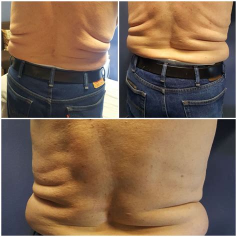 Albums 91+ Pictures Lipo Cavitation Before And After Pictures Full HD ...