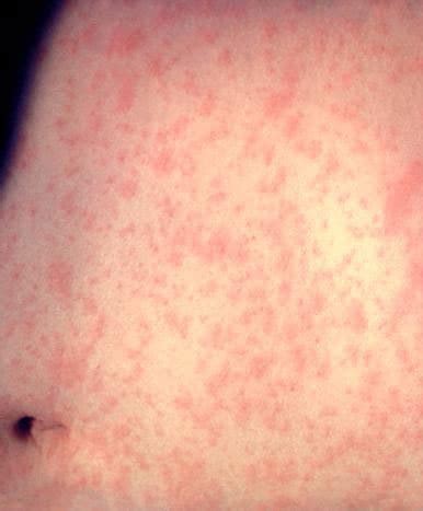 Photos of Measles | Measles (Rubeola) | CDC