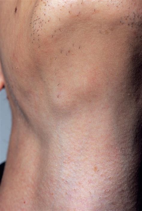 Swollen Glands Photograph by Dr P. Marazzi/science Photo Library