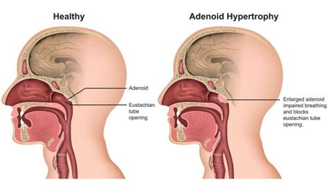 Adenoidectomy – Dr Arjuna Ananda