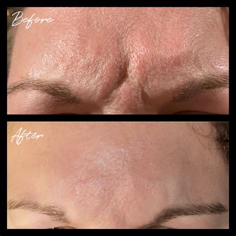 Botox, Daxxify, Dysport, Jeuveau | Before and After |Ann Arbor