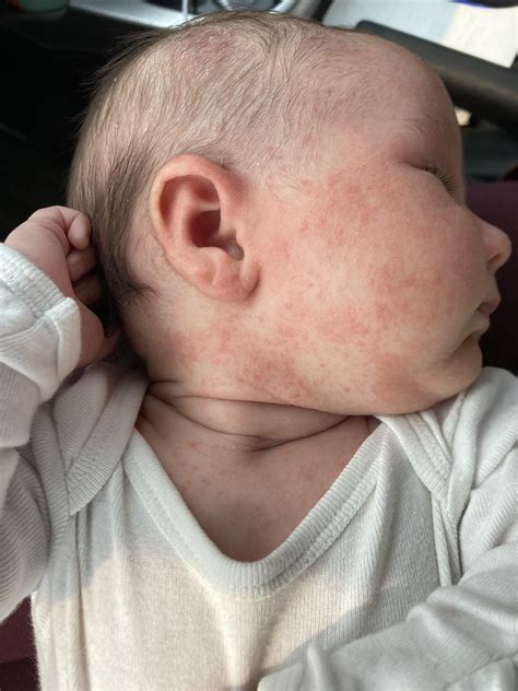 Yeast Diaper Rash Boys Yeast Diaper Rash: How To Treat It Fast!