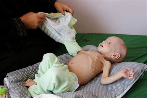 Children are starving in Yemen. The White House should intervene. - The Washington Post