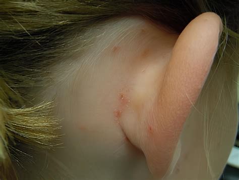 common bug bites    treat