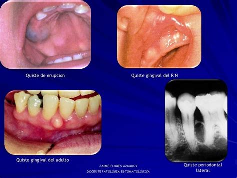 Imagenes Patologia Bucal