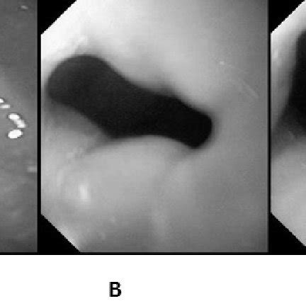 The Lower Esophageal Sphincter (LES) relaxation induced by a... | Download Scientific Diagram