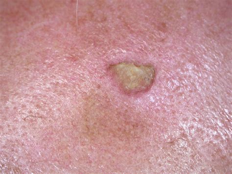 Actinic keratosis - Dr Jonathan Bowling