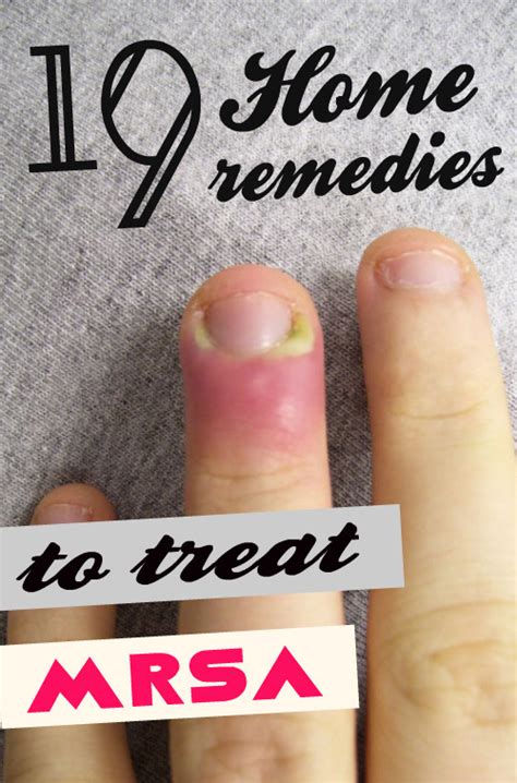how to treat mrsa at home
