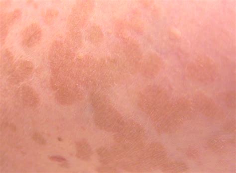 Tinea versicolor – Pictures, Symptoms, Causes, Treatment